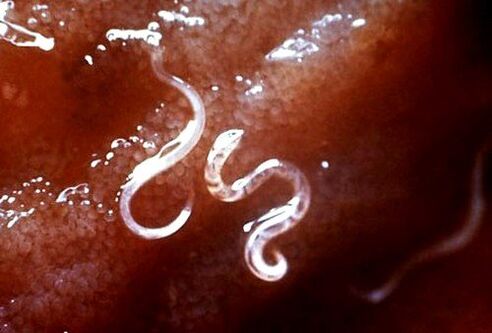 Παράσιτα στο σώμα